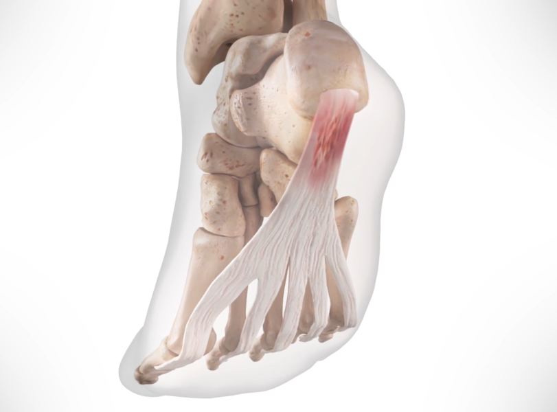 Plantar Fasciitis